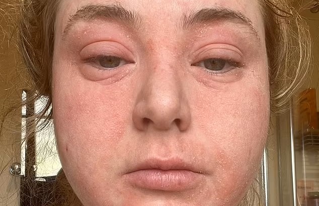 Kvinde fik smertefuldt “elefanthud” i hele ansigt og krop efter tandbehandling: Sådan går det hende i dag