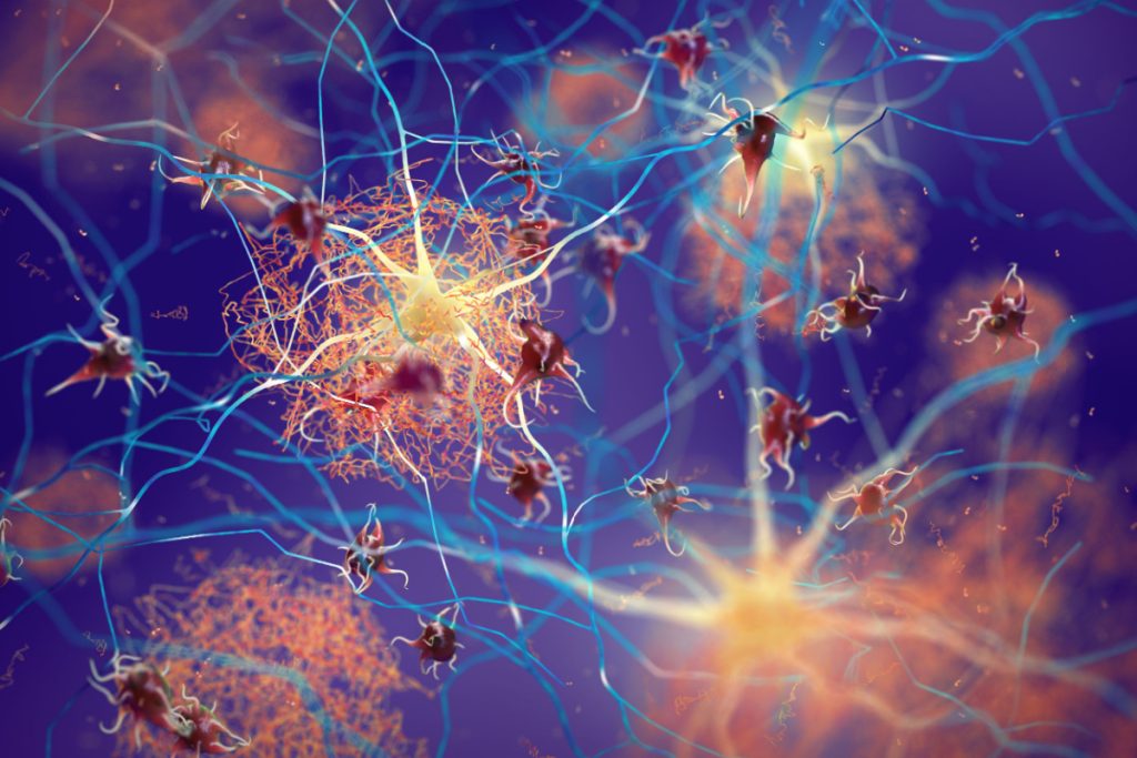 Mulig ny og overraskende synder: Kan medvirke til udvikling af Alzheimers