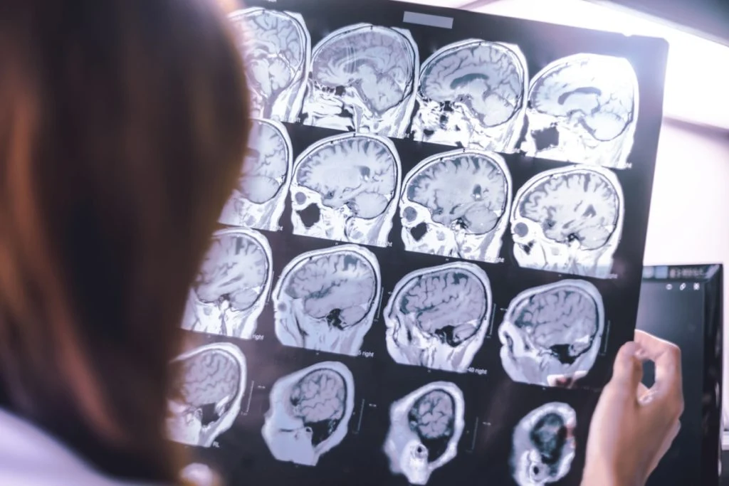 Nyt lægemiddel i kampen mod alzheimers: Forskere kalder det et gennembrud