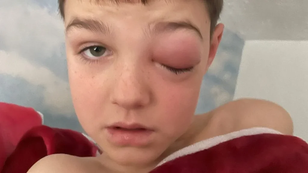 Dreng på ni år næsten blind: Fik ‘corona-øje’