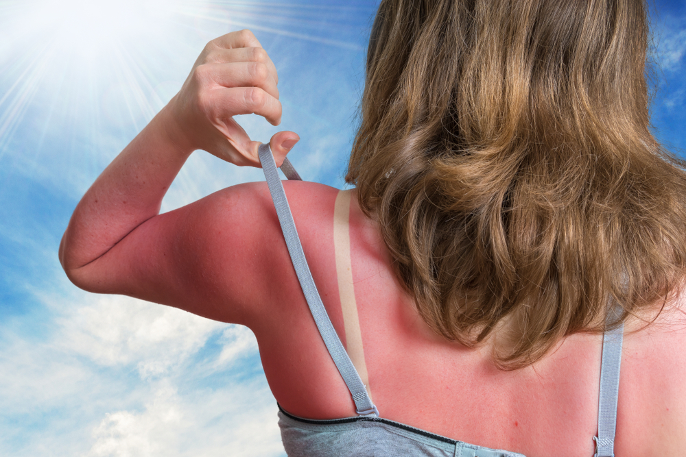 Inden sommerferien: Sådan plejer du bedst huden ved solskoldning ifølge dermatolog