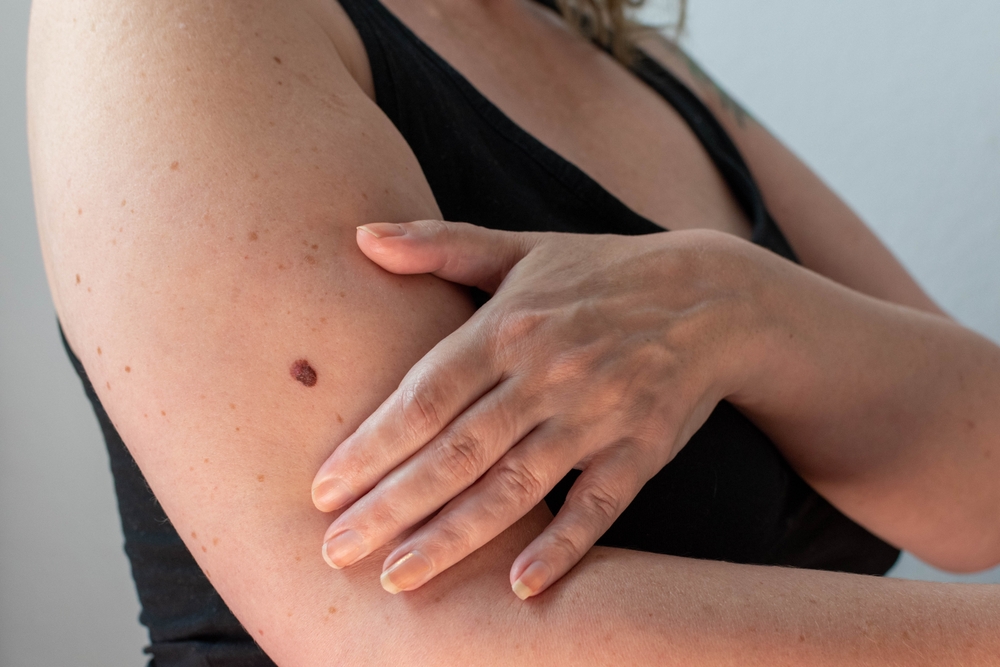 Giver håb om helbredelse: Læger finder mulig vaccine mod hudkræft