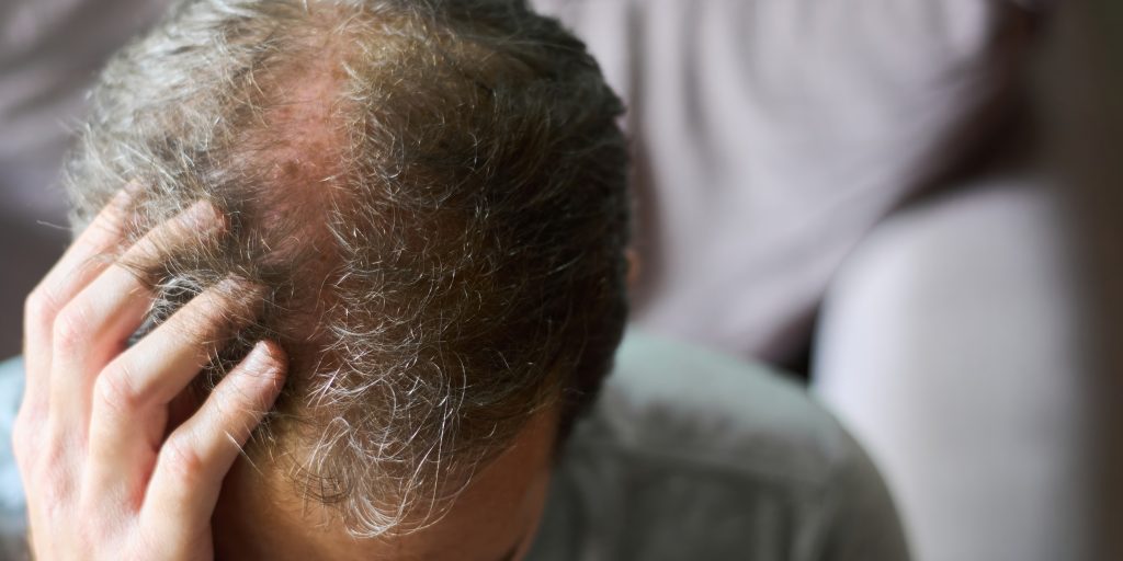 Læge forklarer: Dette kan være grunden til, at dit hår falder af