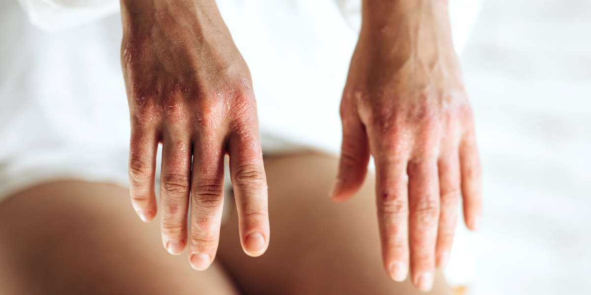 500.000 danskere overses i ny sundhedsreform mener forening
