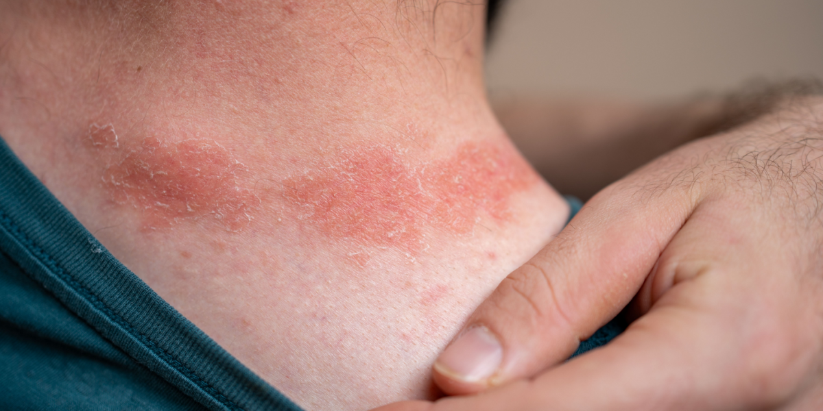 Rammer 4-5 procent af alle danskere: Nu har forskere udviklet særligt plaster mod psoriasis