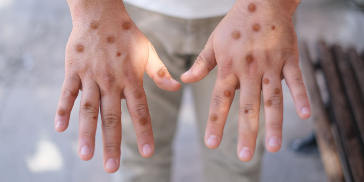 mpox har muteret – forskere frygter øgets spredning